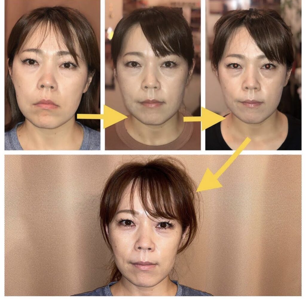 施術を重ねる中でのエラ周りとフェイスラインの変化