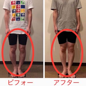 Read more about the article 膝を矯正してもガニ股・O脚が改善しない理由